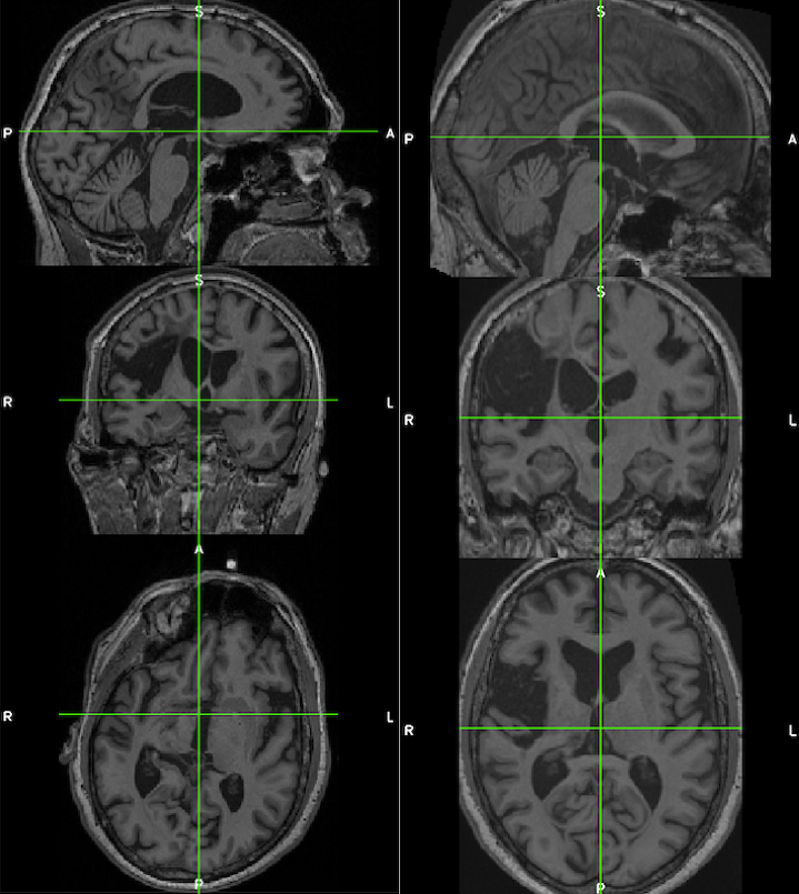A second subject: Brain images in 3 planes: Native on the left and MNI on the right. This illustrates the corrected alignment which benefits lesion drawing