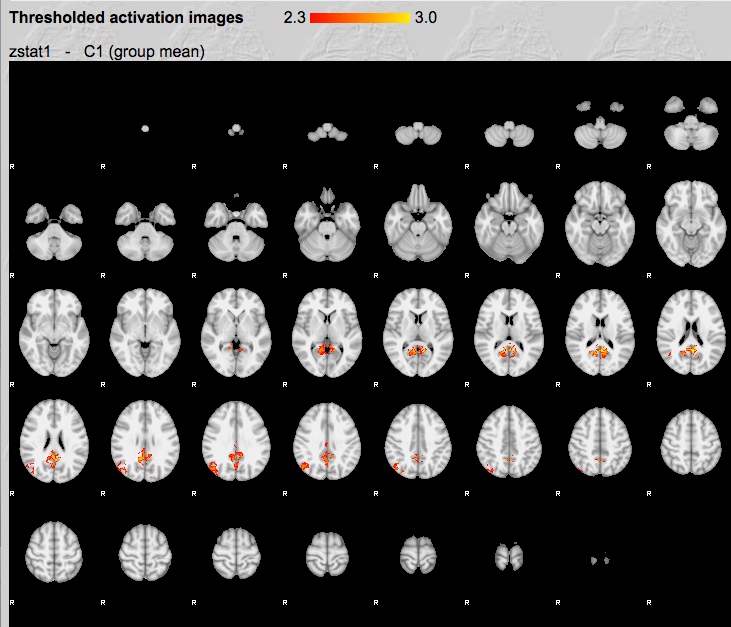 A lightbox image of axial slices for the higher level analysis: The slices show the regions with activity correlated to the posterior cingulate roi we selected earlier