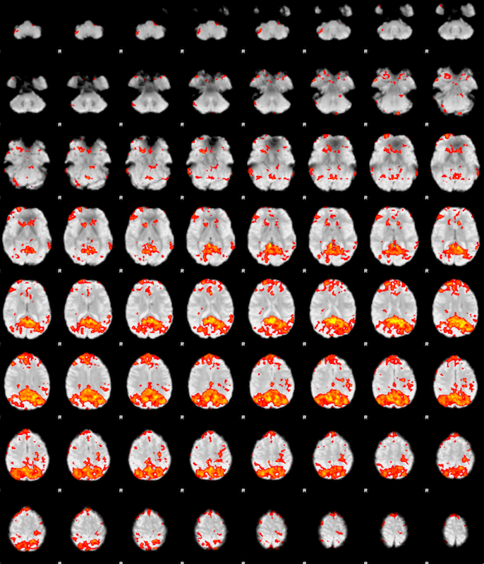 A lightbox image of axial slices for sub-001: The slices show the regions with activity correlated to the posterior cingulate roi we selected earlier