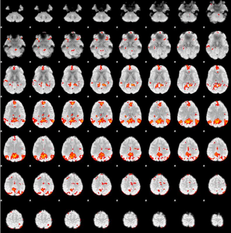 A lightbox image of axial slices for sub-002: The slices show the regions with activity correlated to the posterior cingulate roi we selected earlier