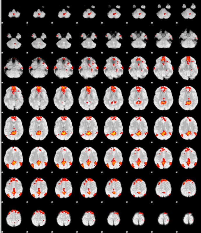 A lightbox image of axial slices for sub-003: The slices show the regions with activity correlated to the posterior cingulate roi we selected earlier