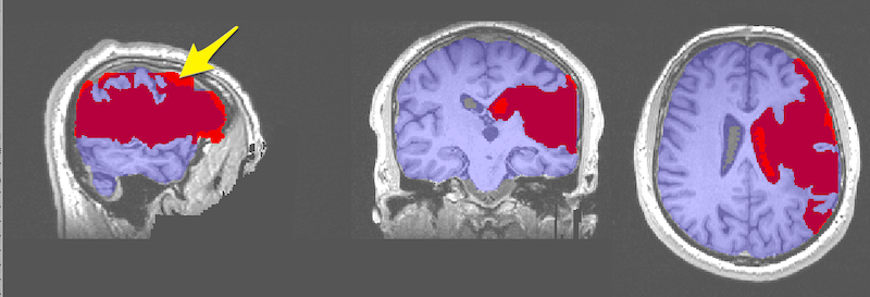 Using a brain mask to limit the spread of the lesion mask outside the brain. Yellow arrow points to lesion mask that grew outside the brain mask