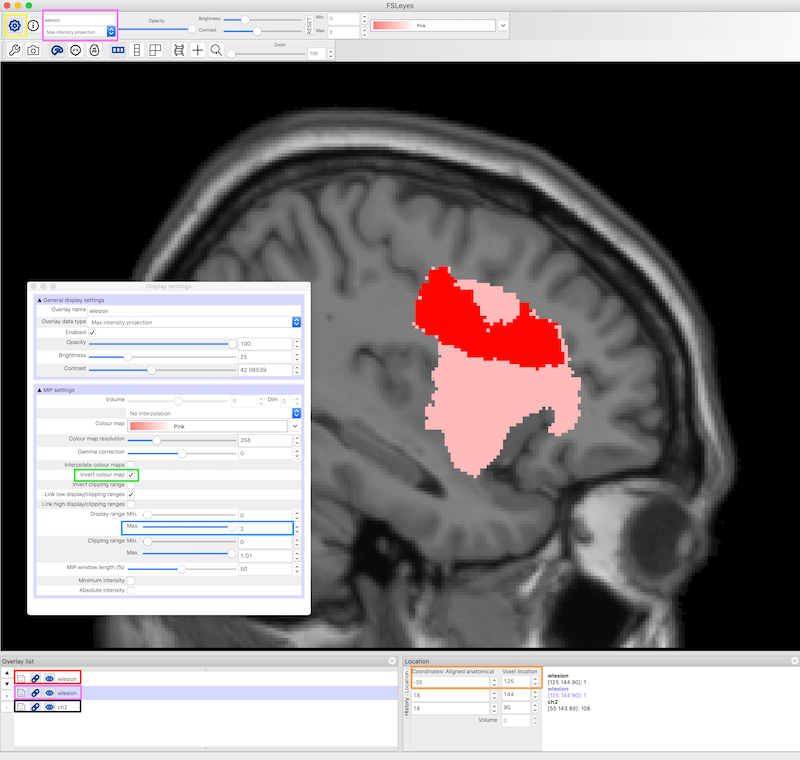 fsleyes interface elements for controlling multiple overlays: the lesion mask and the MIP projection of the lesion mask