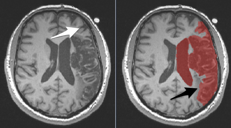 an axial slice through a large lesion displayed in fsleyes. On the left the lesion is not masked: the white arrow points to an area of normal tissue that the algorithm identifies as lesion. On the right the lesion is masked: the black arrow points to an area of abnormal tissue that the algorithm missed.