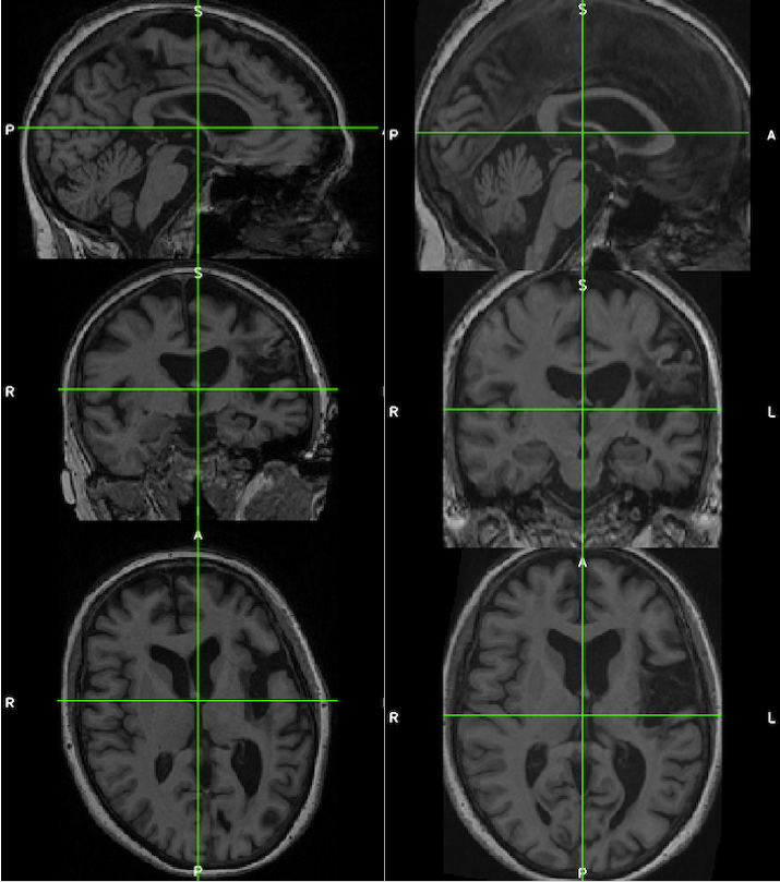 Brain images in 3 planes: Native on the left and MNI on the right. This illustrates the corrected alignment which benefits lesion drawing